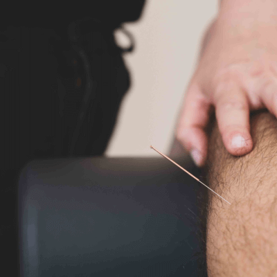 Dry needling  - sfeerbeeld 4